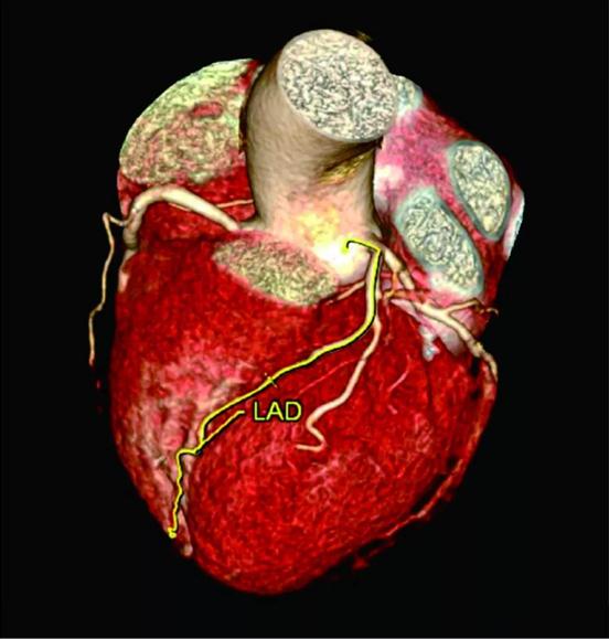 双源CT心脏冠脉造影.jpg