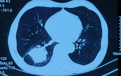 【病例】肿瘤科成功进行肺癌微创介入治疗，手术成功