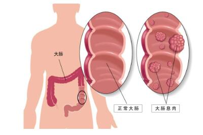 肠道息肉不容忽视，如何阻断肠息肉变癌之路